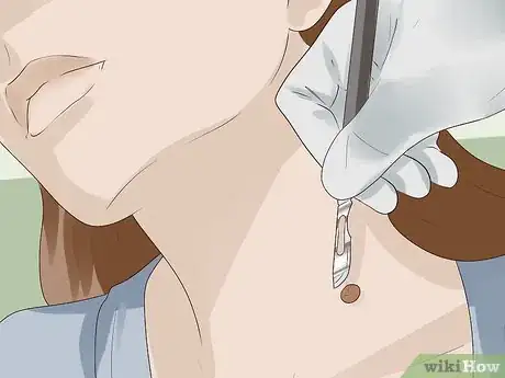 Image intitulée Get Rid of Skin Tags Step 2