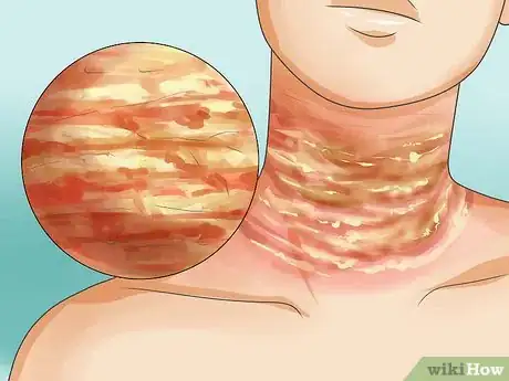 Image intitulée Recognize Scabies Rash Step 5