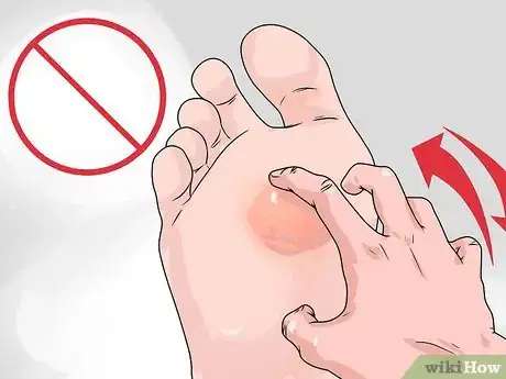 Image intitulée Care for a Burst Blister Step 9