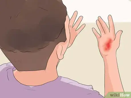 Image intitulée Treat a Hand Burn Step 3