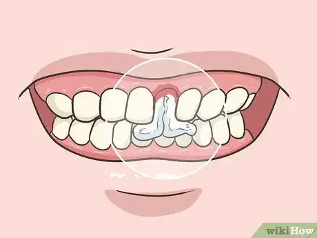 Image intitulée Pull a Loose Tooth at Home Step 10