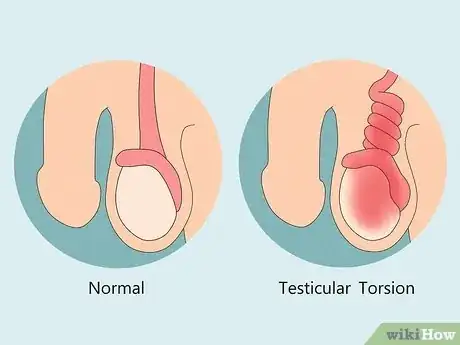 Image intitulée Treat Pain and Swelling in the Testicles Step 7