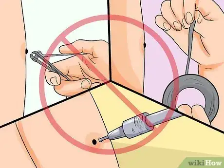 Image intitulée Remove a Raised Mole Step 7