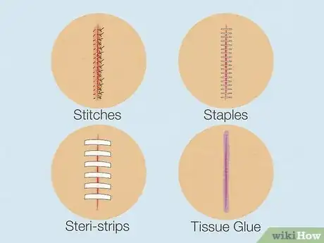 Image intitulée Take a Shower After Surgery Step 2