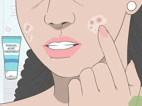 Image intitulée Create a Hot Compress for Acne Treatment and Skin Health Step 10