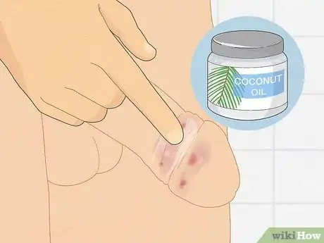 Image intitulée Cure Balanitis Step 4