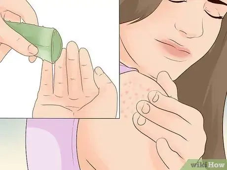 Image intitulée Treat Eczema Naturally Step 8