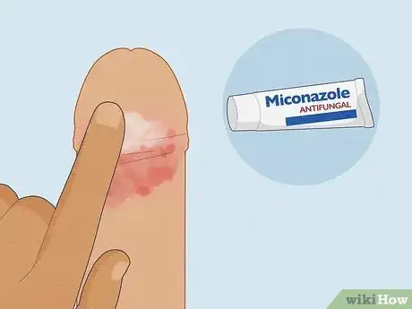 Image intitulée Cure Balanitis Step 9