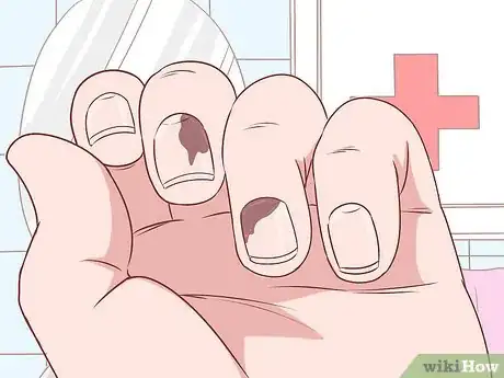 Image intitulée Deal With the Pain of a Door Being Shut on Your Finger Step 10