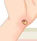 traiter un pinçon