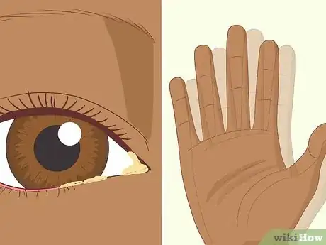 Image intitulée Clear a Blocked Tear Duct Step 2