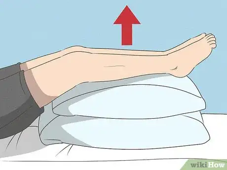 Image intitulée Treat Cellulitis Step 12