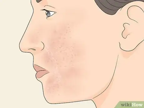 Image intitulée Heal over Exfoliated Skin Step 1
