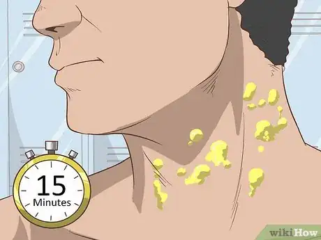 Image intitulée Get Rid of Neck Acne Step 16