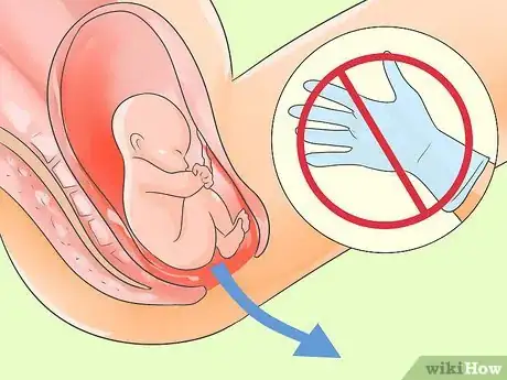 Image intitulée Deliver a Baby Step 17