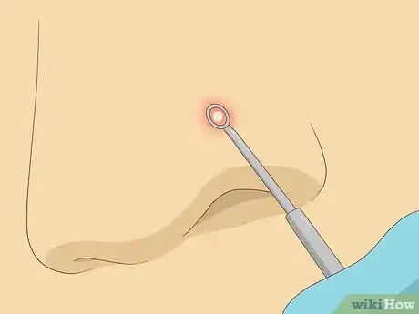 Image intitulée Treat Whiteheads Step 10