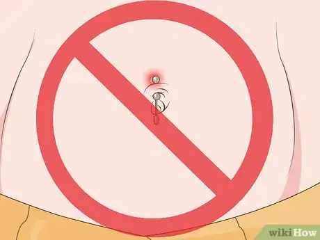 Image intitulée Get Rid of Keloids Step 13