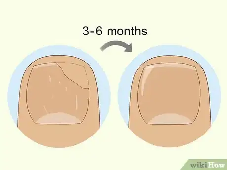 Image intitulée Heal Damaged Nails Step 19