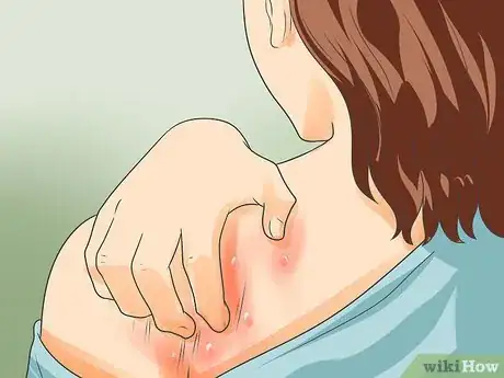 Image intitulée Recognize Scabies Rash Step 1