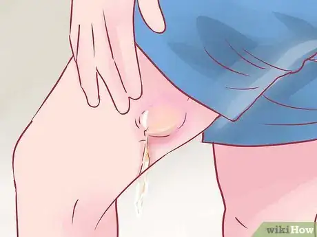 Image intitulée Recognize Boils Step 6