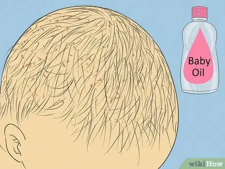 Image intitulée Know What to Expect on a Newborn's Skin Step 8