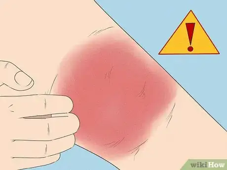 Image intitulée Treat Cellulitis Step 13