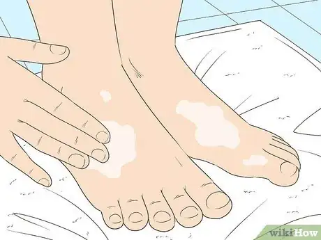 Image intitulée Treat Cellulitis Step 14
