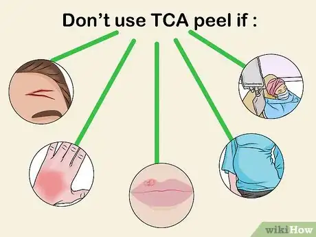 Image intitulée Apply a TCA Peel Step 1
