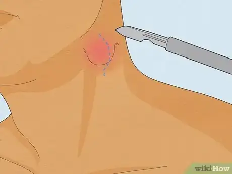 Image intitulée Reduce Lymph Node Swelling Step 12