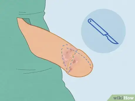 Image intitulée Cure Balanitis Step 13