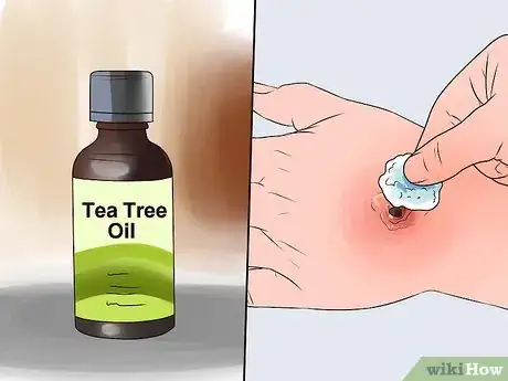 Image intitulée Cure Boils Naturally Step 3