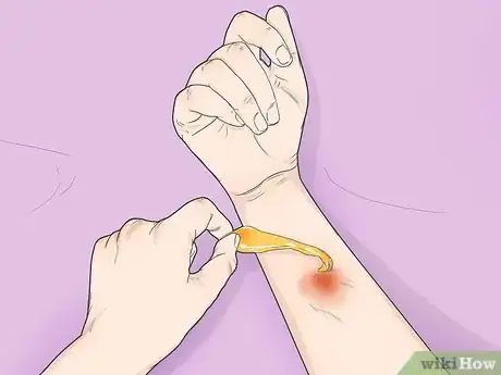 Image intitulée Treat Wax Burns Step 2