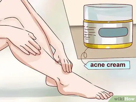 Image intitulée Get Rid of Leg Acne Step 8