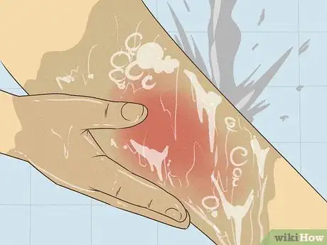 Image intitulée Treat Cellulitis Step 11