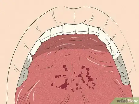 Image intitulée Differentiate Bacterial Tonsillitis and Viral Tonsillitis Step 5