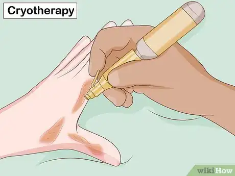 Image intitulée Get Rid of Keloids Step 7
