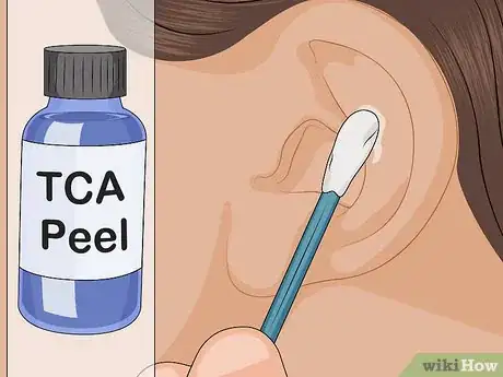 Image intitulée Apply a TCA Peel Step 4