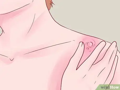 Image intitulée Recognize Boils Step 4