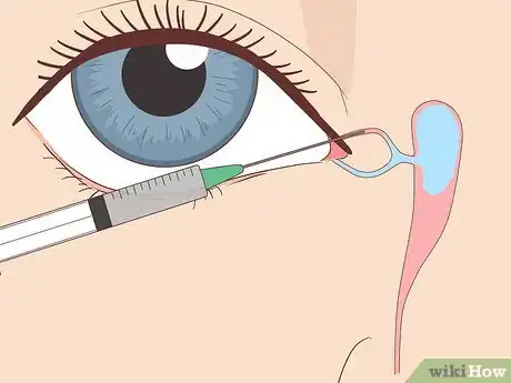 Image intitulée Clear a Blocked Tear Duct Step 10