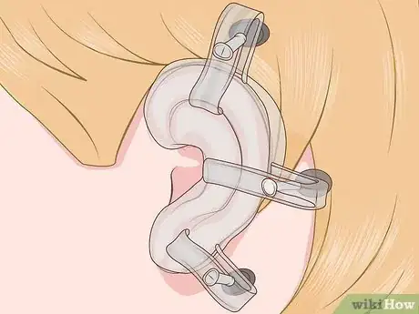 Image intitulée Get Rid of Keloids Step 8