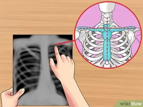 Image intitulée Read a Chest X Ray Step 6