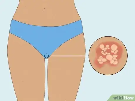 Image intitulée Get Rid of a Rash Between Your Legs Step 12