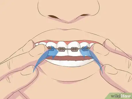 Image intitulée Make Fake Braces or a Fake Retainer Step 10