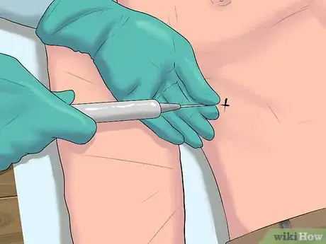 Image intitulée Know if You Have an Enlarged Liver Step 14