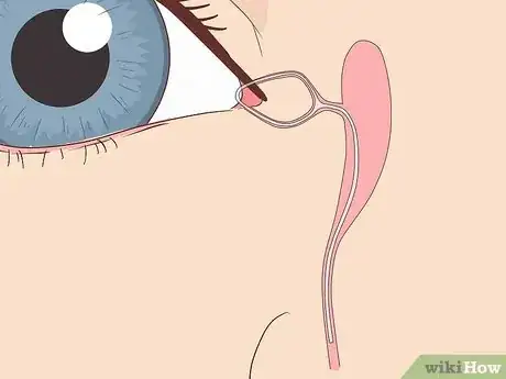 Image intitulée Clear a Blocked Tear Duct Step 11