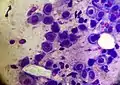 Acantholytic cells on a smear taken from a patient with pemphigus foliaceus (May-Grünwald Giemsa x1000).