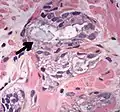 Acinar adenocarcinoma with intraluminal blue mucin.