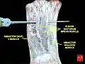 Abductor hallucis muscle