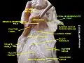 Lateral Glossoepiglottic fold