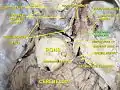 Trigeminal ganglion